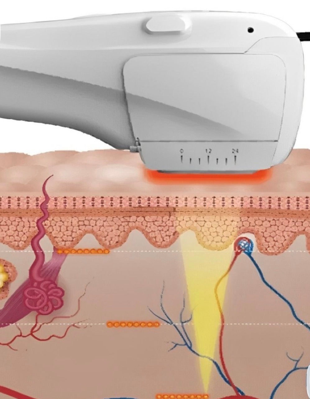 Programa reductivo reafirmante corporal HIFU (3 sesiones)