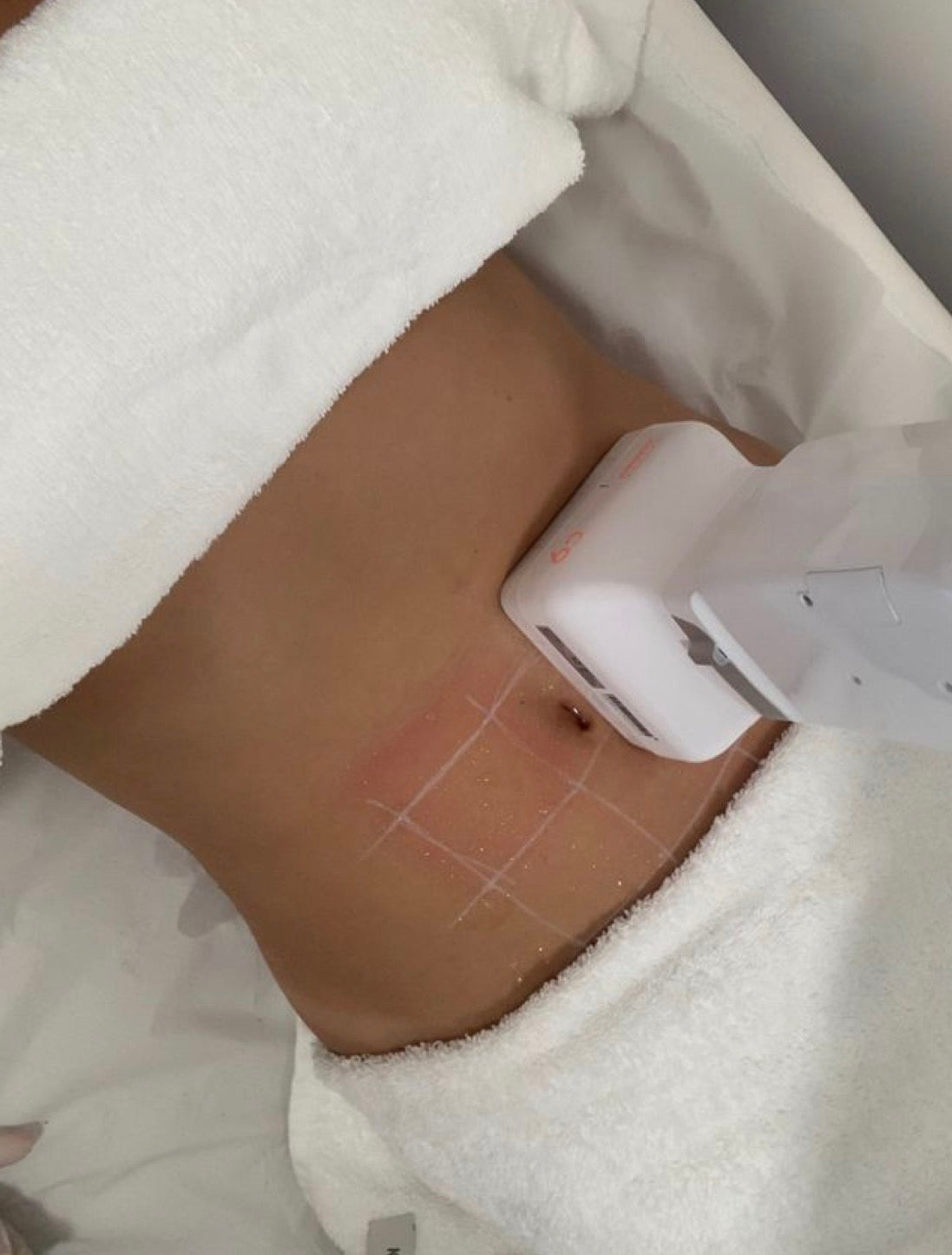 Programa reductivo reafirmante corporal HIFU (3 sesiones)